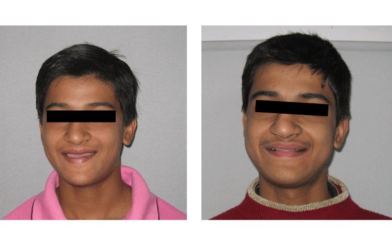 Orthodontic case 01 Class III