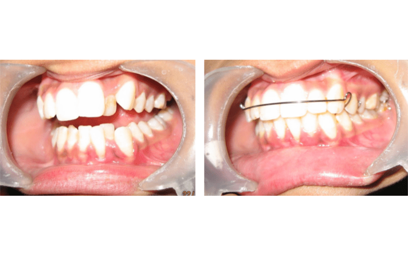 Anterior Crossbite image 2