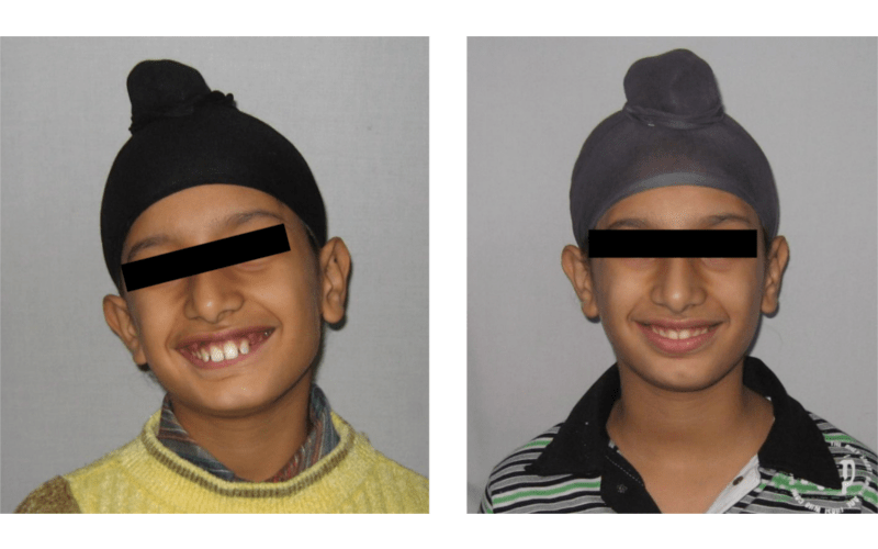 Orthodontic case 03 Class II Div 1