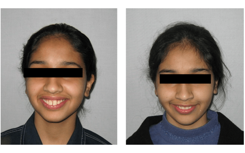 Orthodontic case 04 Class II Div 1