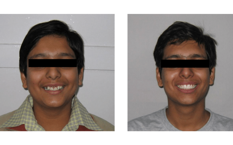 Orthodontic case 05 Class II Div 2
