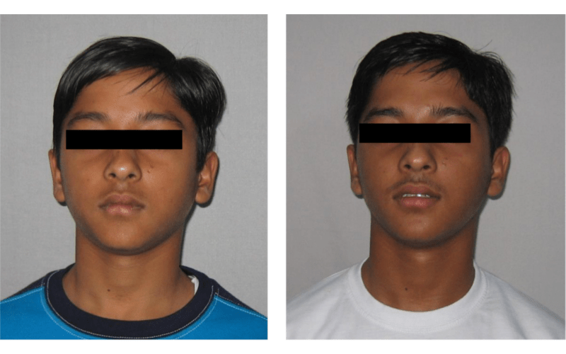 Ectopic Eruption image 1