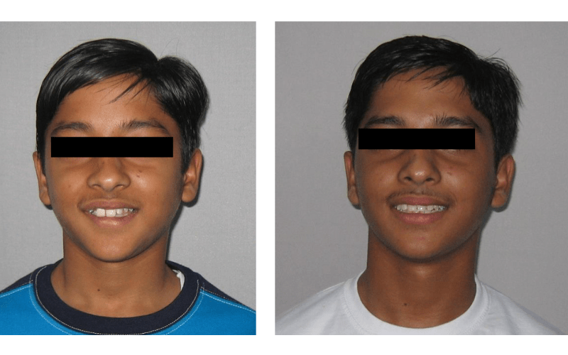 Orthodontic case 06 Ectopic Eruption