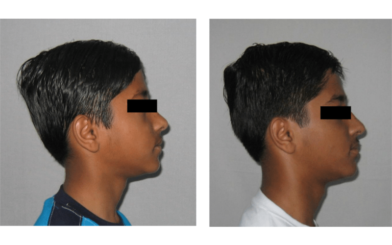 Ectopic Eruption image 3