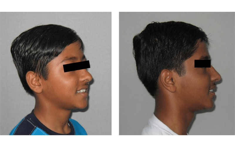 Ectopic Eruption image 4