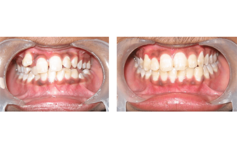 Ectopic Eruption image 5
