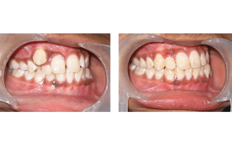 Ectopic Eruption image 6