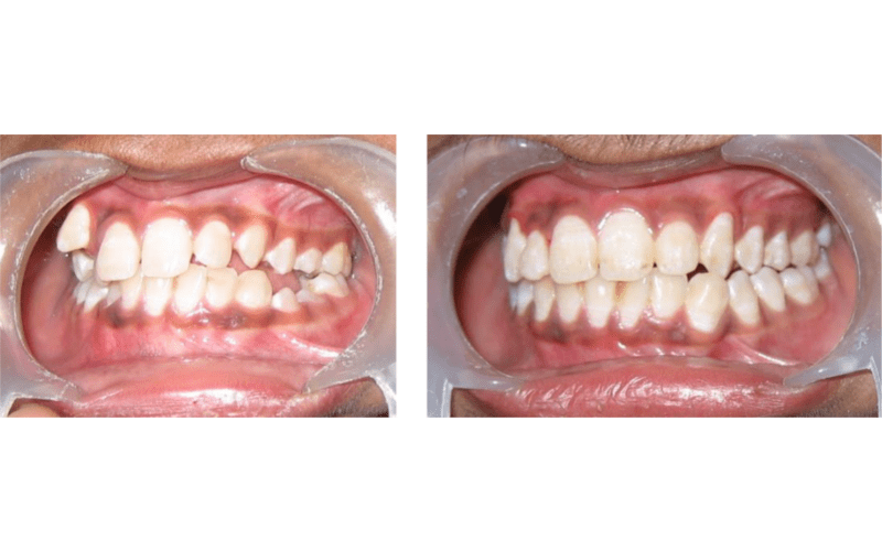 Ectopic Eruption image 7
