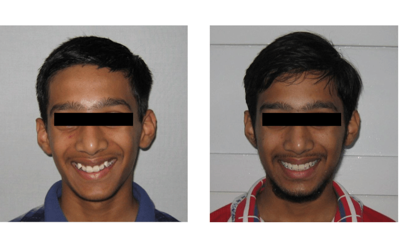 Orthodontic case 09 Class II Div 2