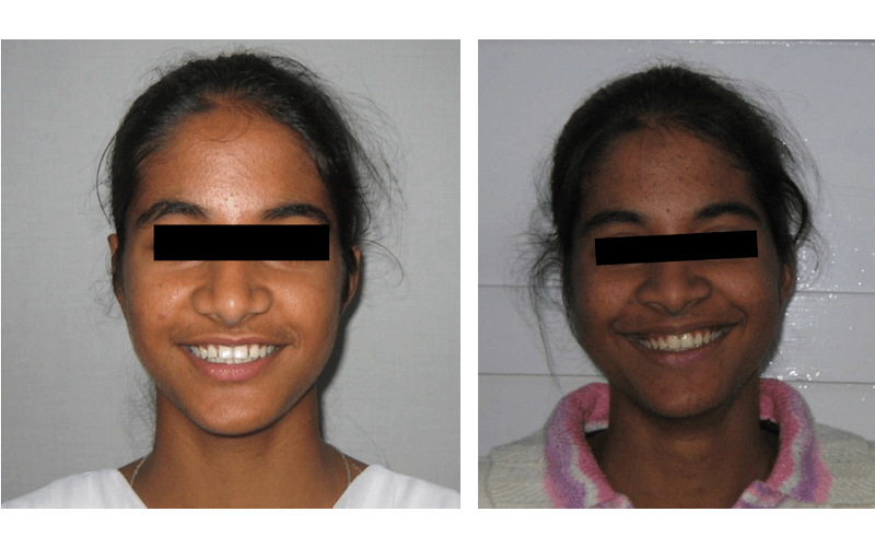 Orthodontic case 10 Class I Type 2