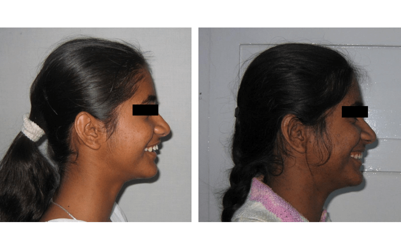 Class I Type 2 image 2