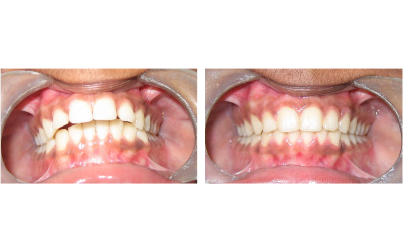 Class I Type 2 image 3