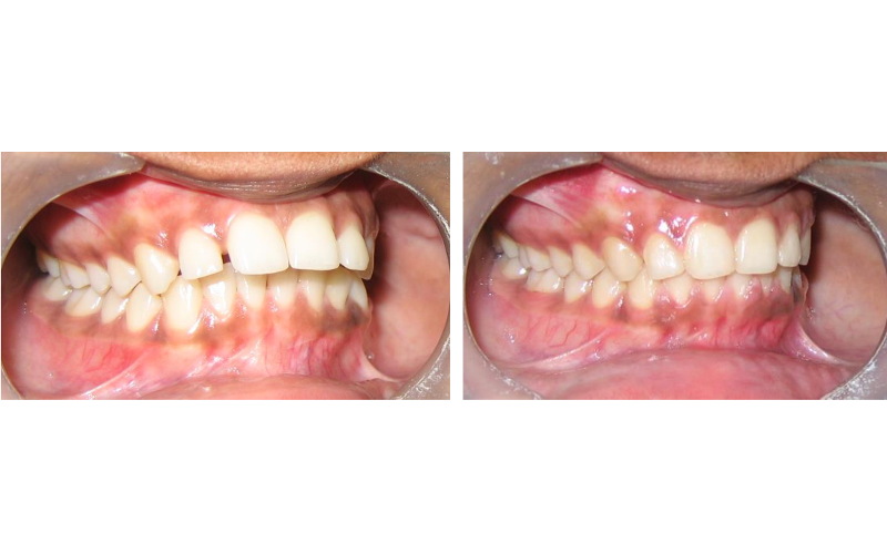 Class I Type 2 image 4