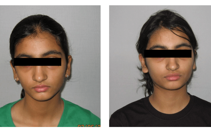 Anterior Deepbite image 1