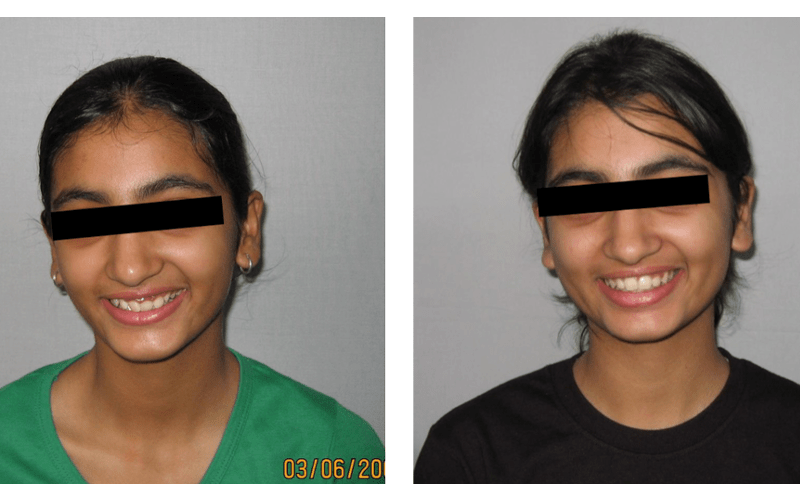 Orthodontic case 13 Anterior Deepbite