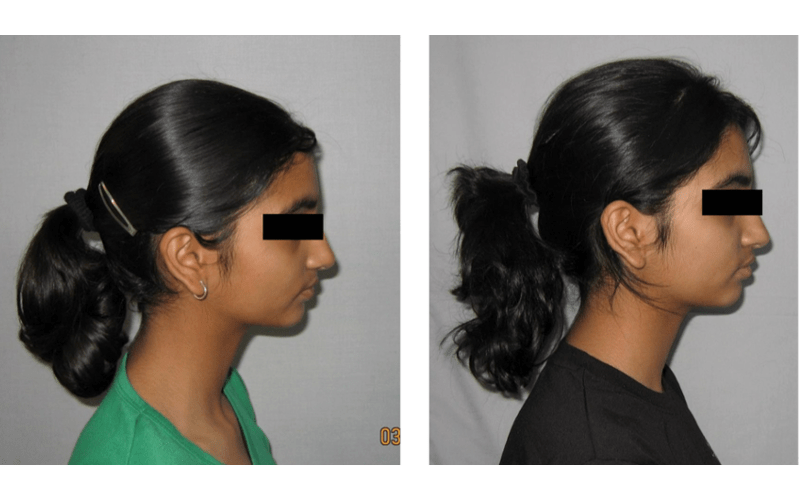 Anterior Deepbite image 3