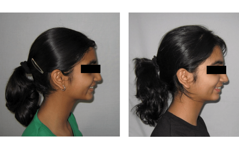 Anterior Deepbite image 4