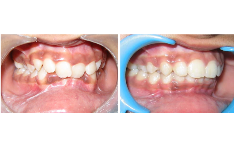 Anterior Deepbite image 6