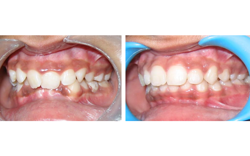 Anterior Deepbite image 7