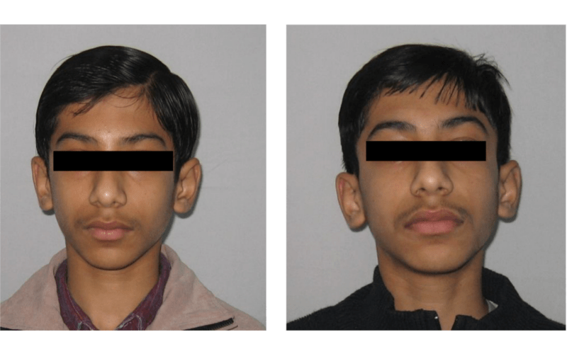 Anterior Deepbite image 1