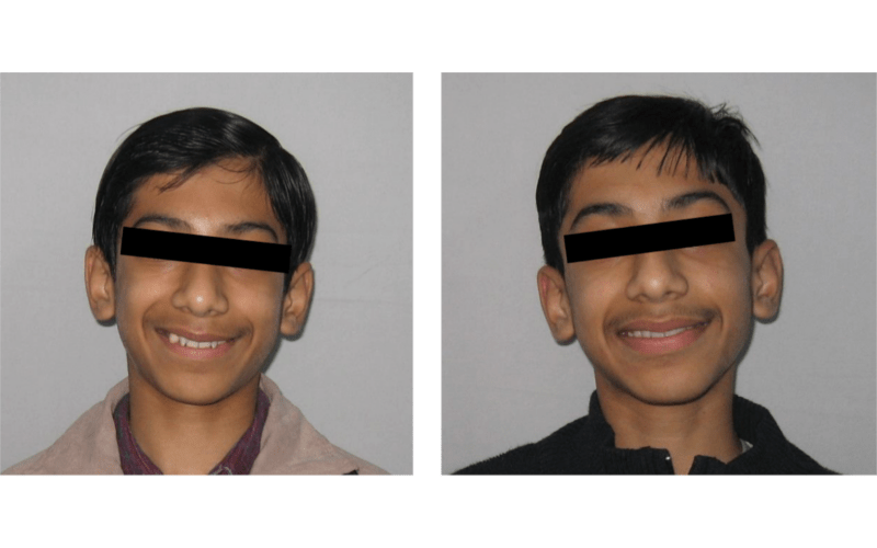 Orthodontic case 14 Anterior Deepbite