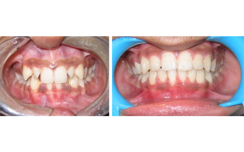 Anterior Deepbite image 3