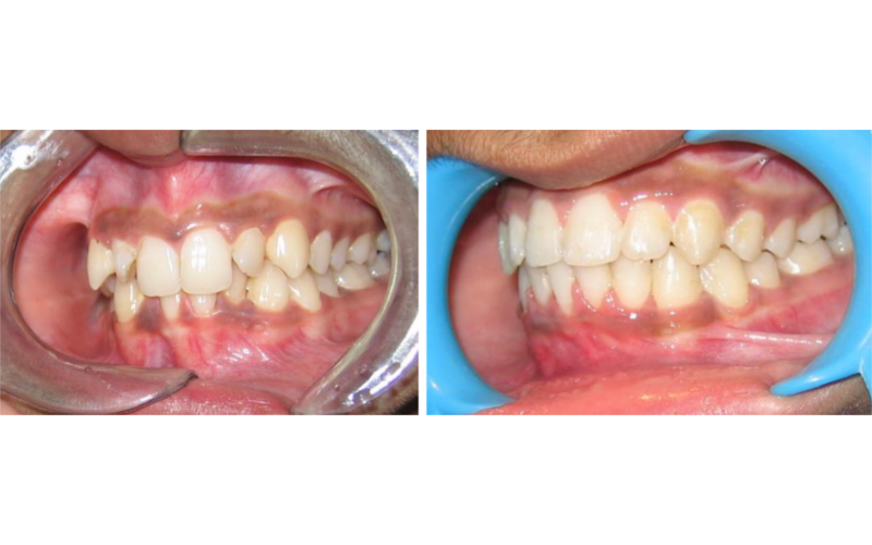 Anterior Deepbite image 5