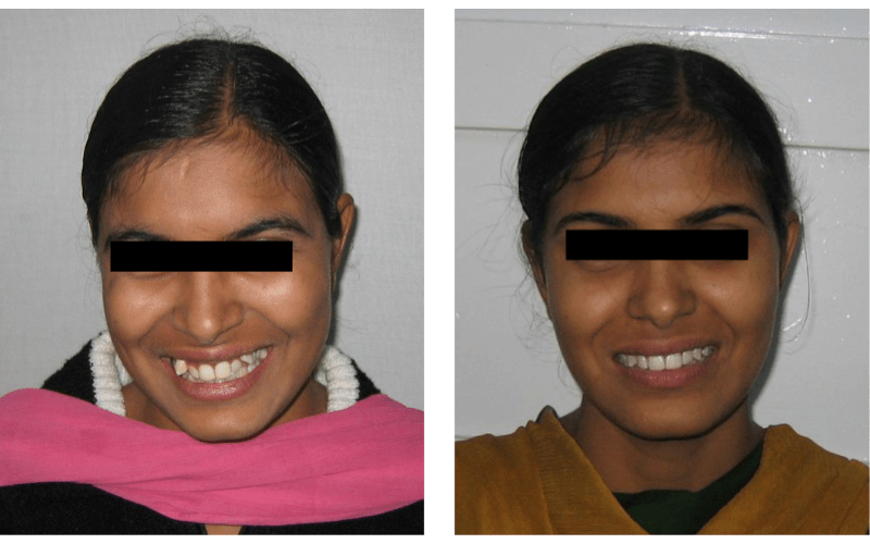 Orthodontic case 15 Class I Type 1