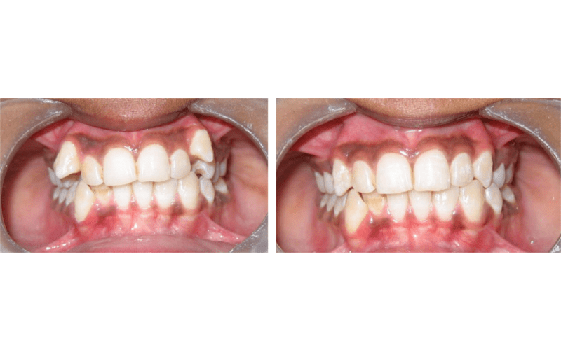 Class I Type 1 image 2