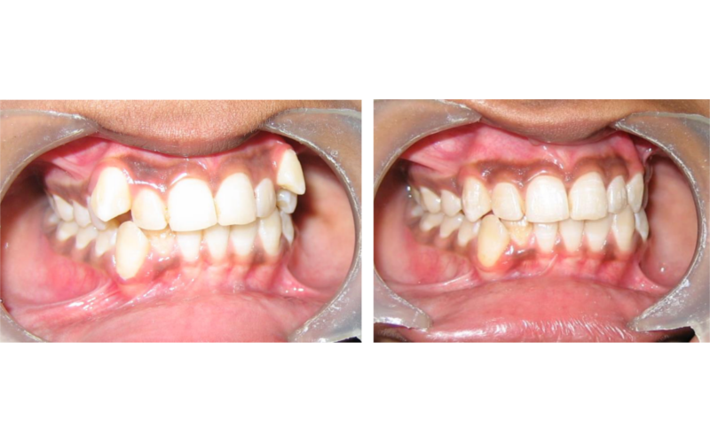 Class I Type 1 image 3