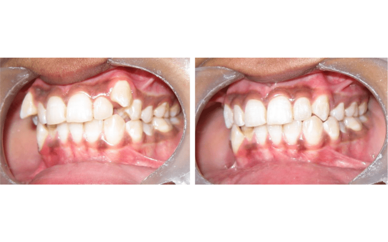 Class I Type 1 image 4