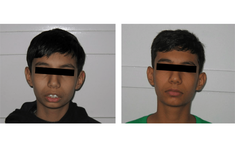 Class II Div 1 (Bimaxillary) image 1