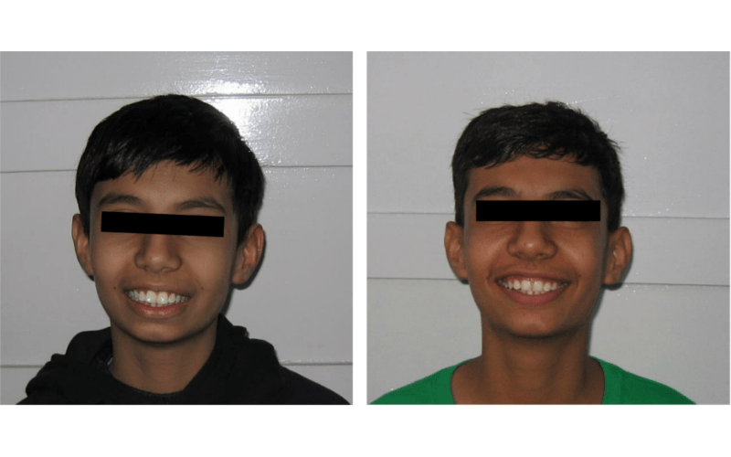 Orthodontic case 16 Class II Div 1 (Bimaxillary)