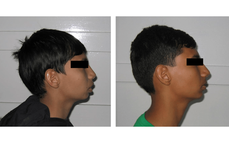 Class II Div 1 (Bimaxillary) image 3