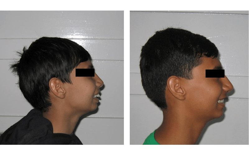 Class II Div 1 (Bimaxillary) image 4