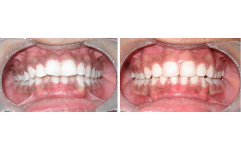 Class II Div 1 (Bimaxillary) image 5