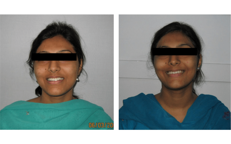 Orthodontic case 17 Class II Div 1 Subdivision