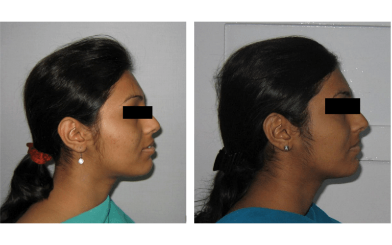 Class II Div 1 Subdivision image 2